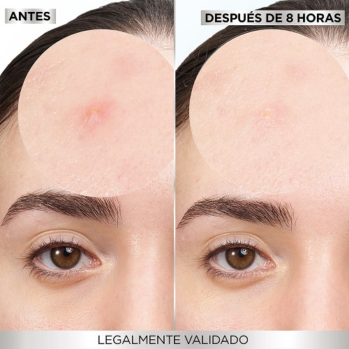 👀 ¿Te salió un grano? ¡Desaparecelo en 8 horas!